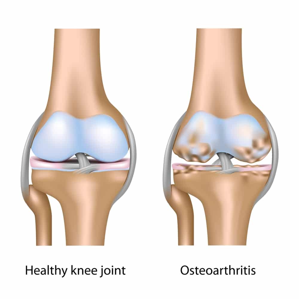 Does Running Cause Knee Arthritis?  Howard J. Luks, MD