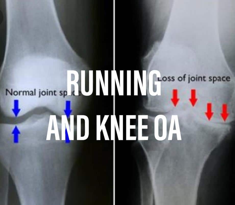 Does Running Increase Your Risk of Knee Arthritis?: Prolete Physical ...