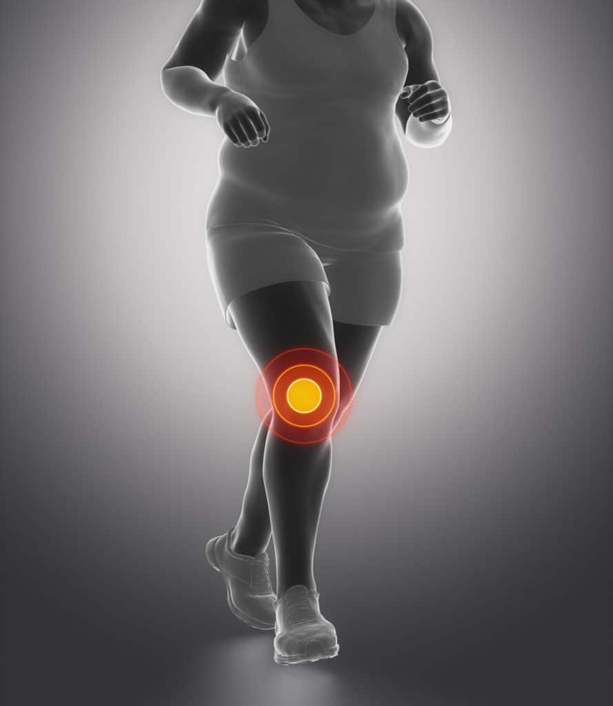 Does Weight Affect Knee Pain?