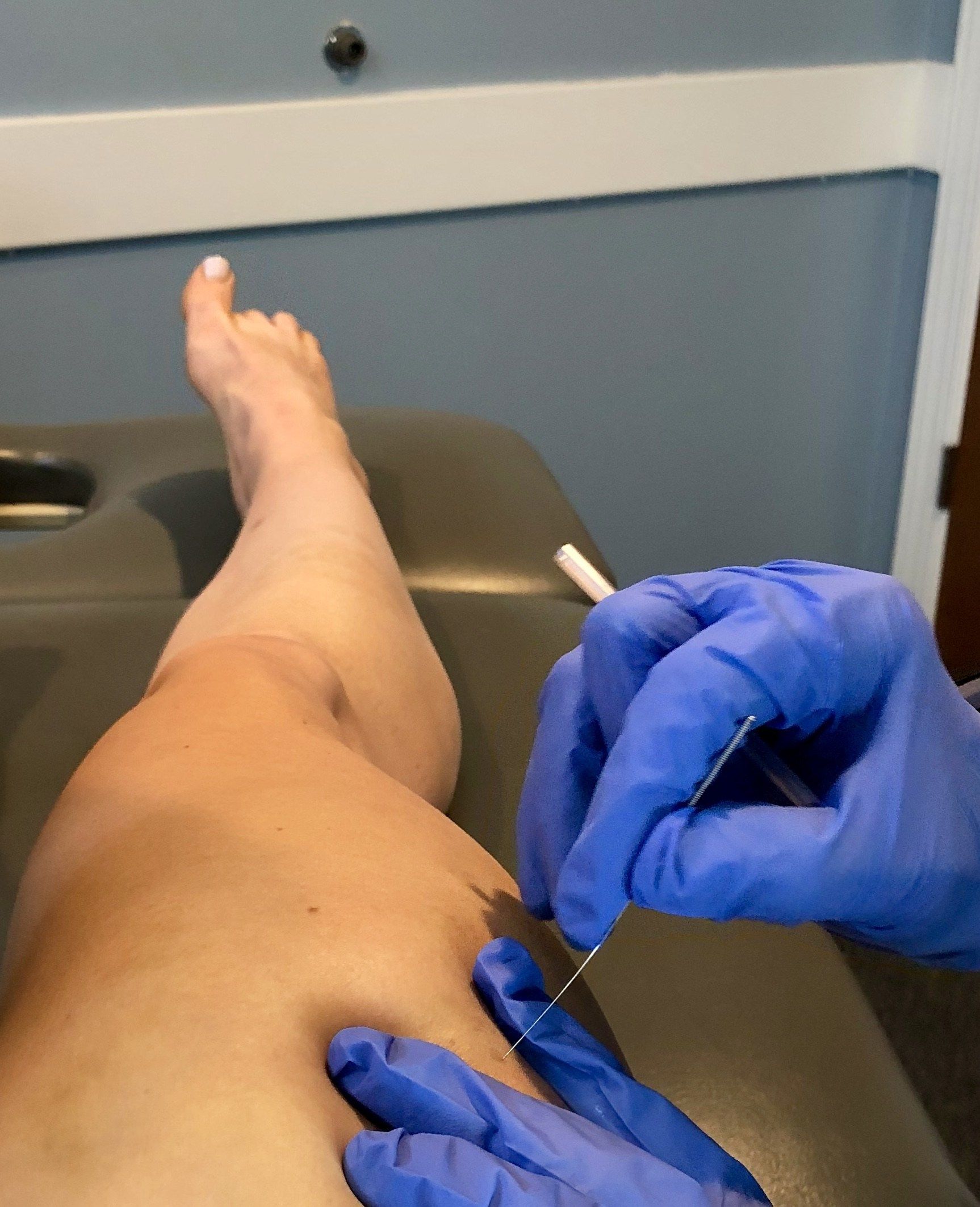 Dry Needling: what it is &  how its helped my running injuries