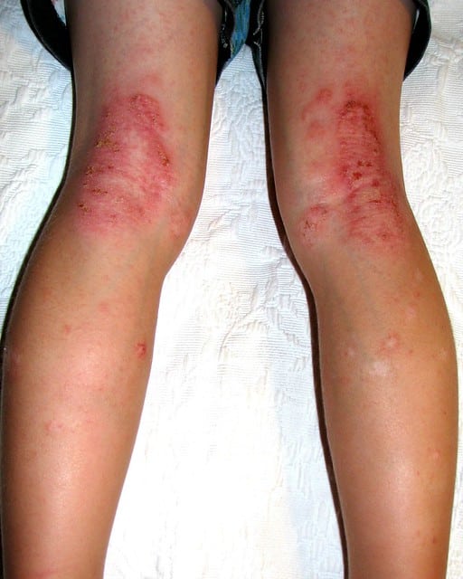 Eczema behind knees and on legs