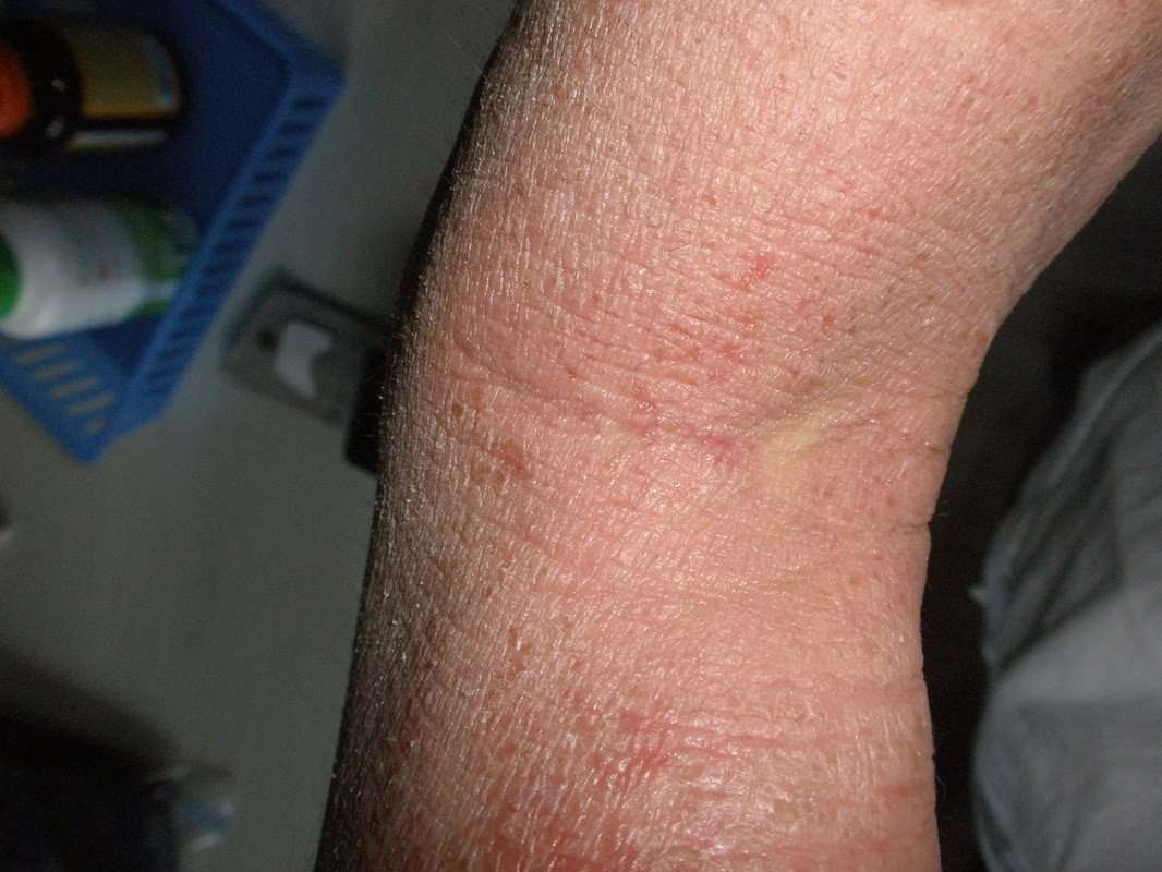 eczema: Eczema Behind Knees