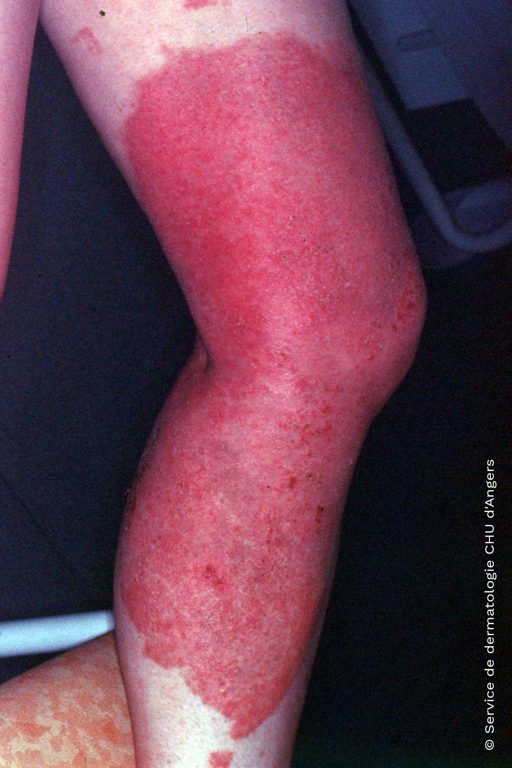 Eczema on the legs