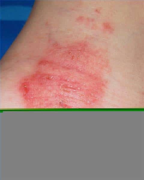 Eczema Treatment Over the Counter