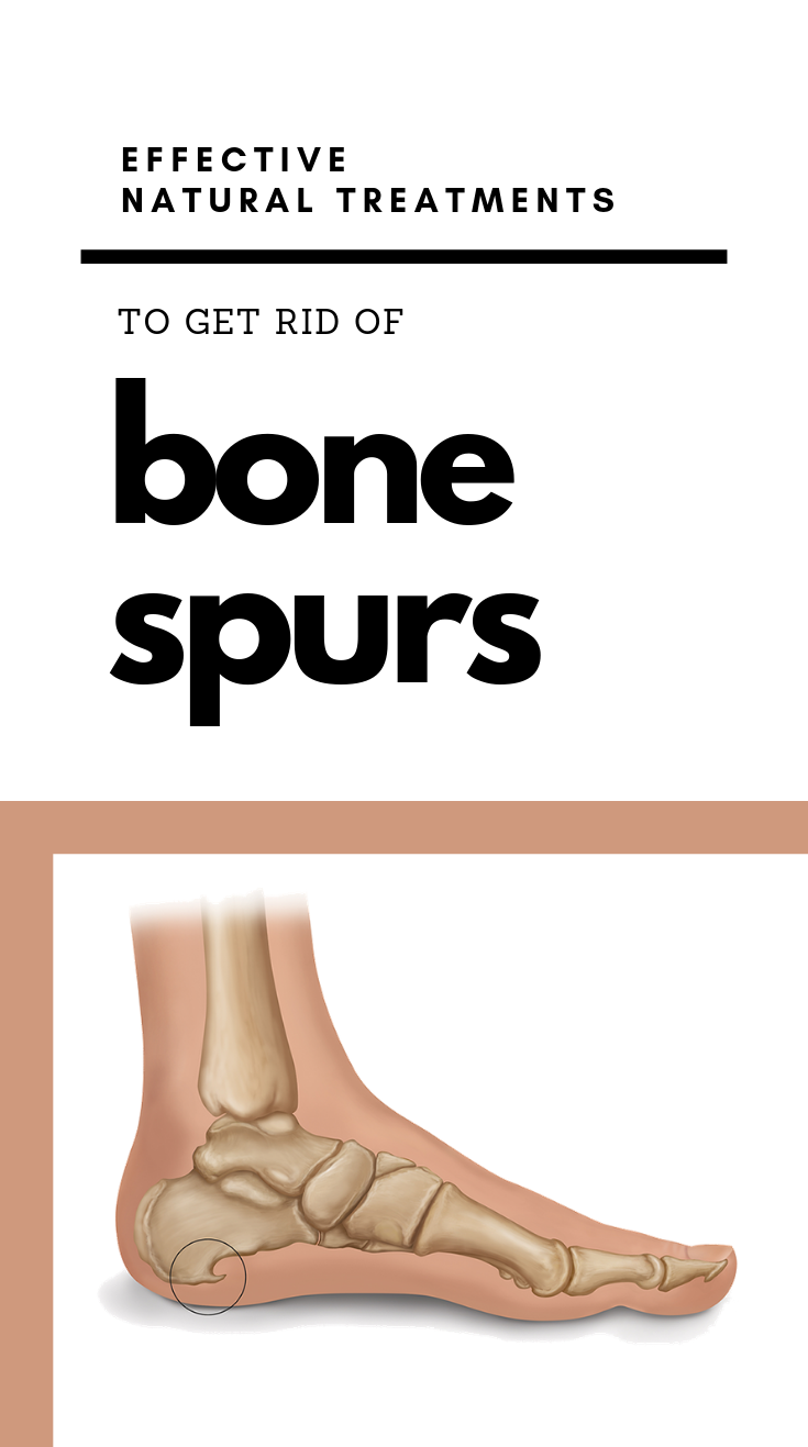 Effective Natural Treatments To Get Rid Of Bone Spurs ...