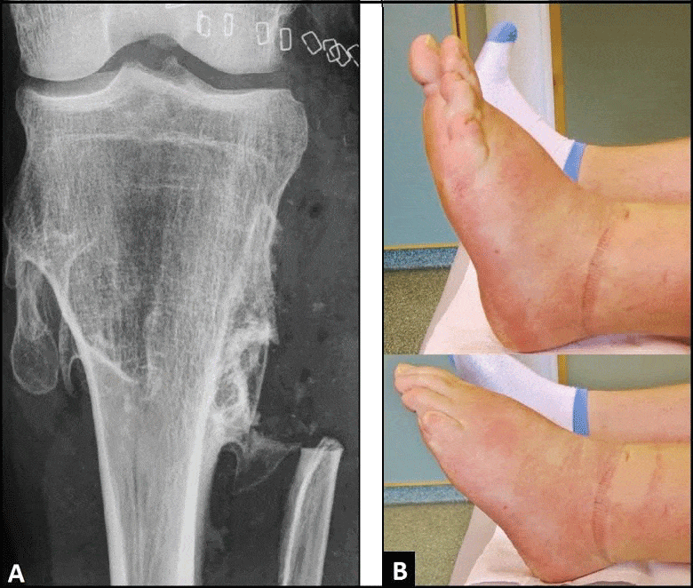 Entrapment of the Common Peroneal Nerve due to Multiple Hereditary ...