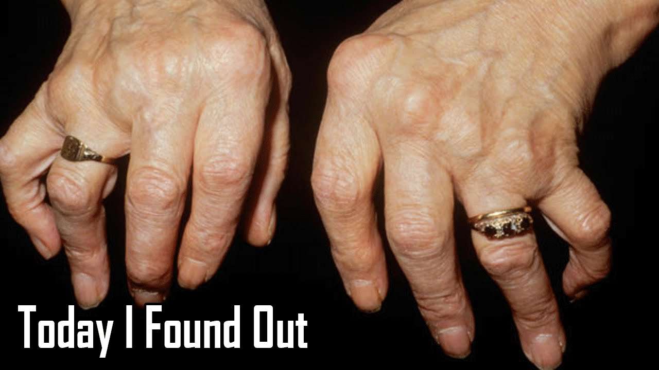 Erudition: Does Cracking Your Knuckles Cause Arthritis?