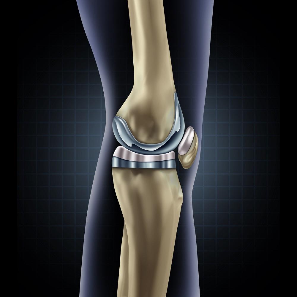 Everything You Need to Know about Total Knee Replacement (Arthroplasty ...