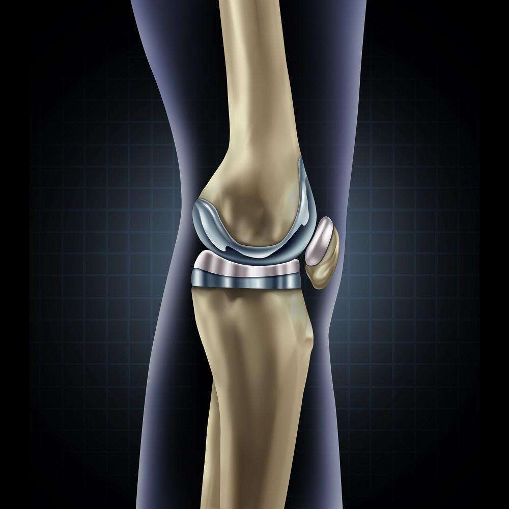 Everything You Need to Know about Total Knee Replacement ...