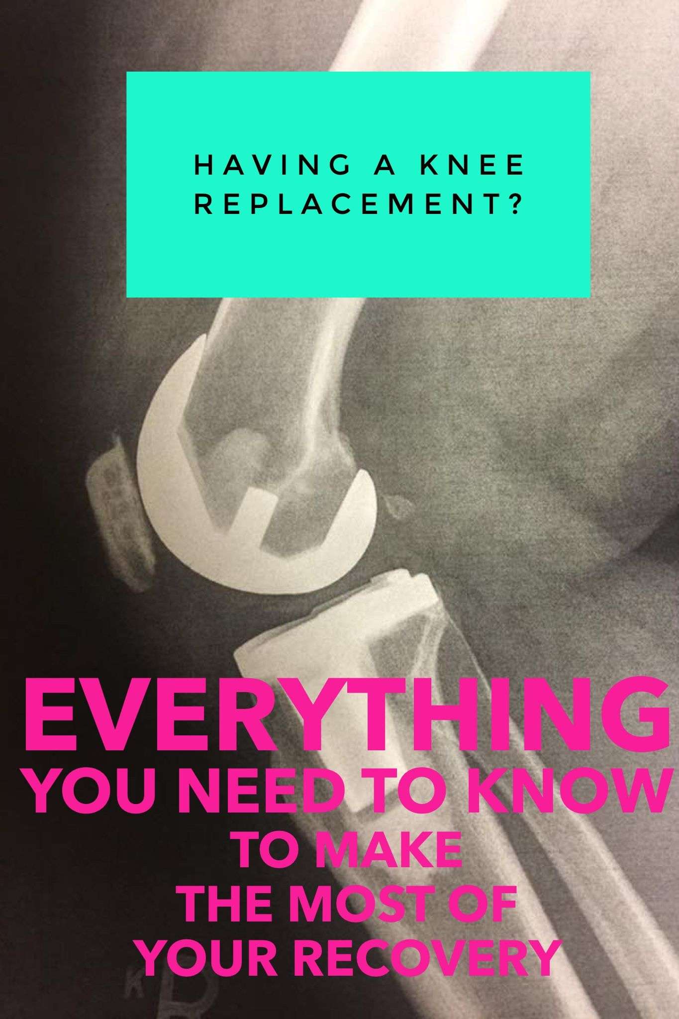 Everything you need to know for your Knee Replacement ...