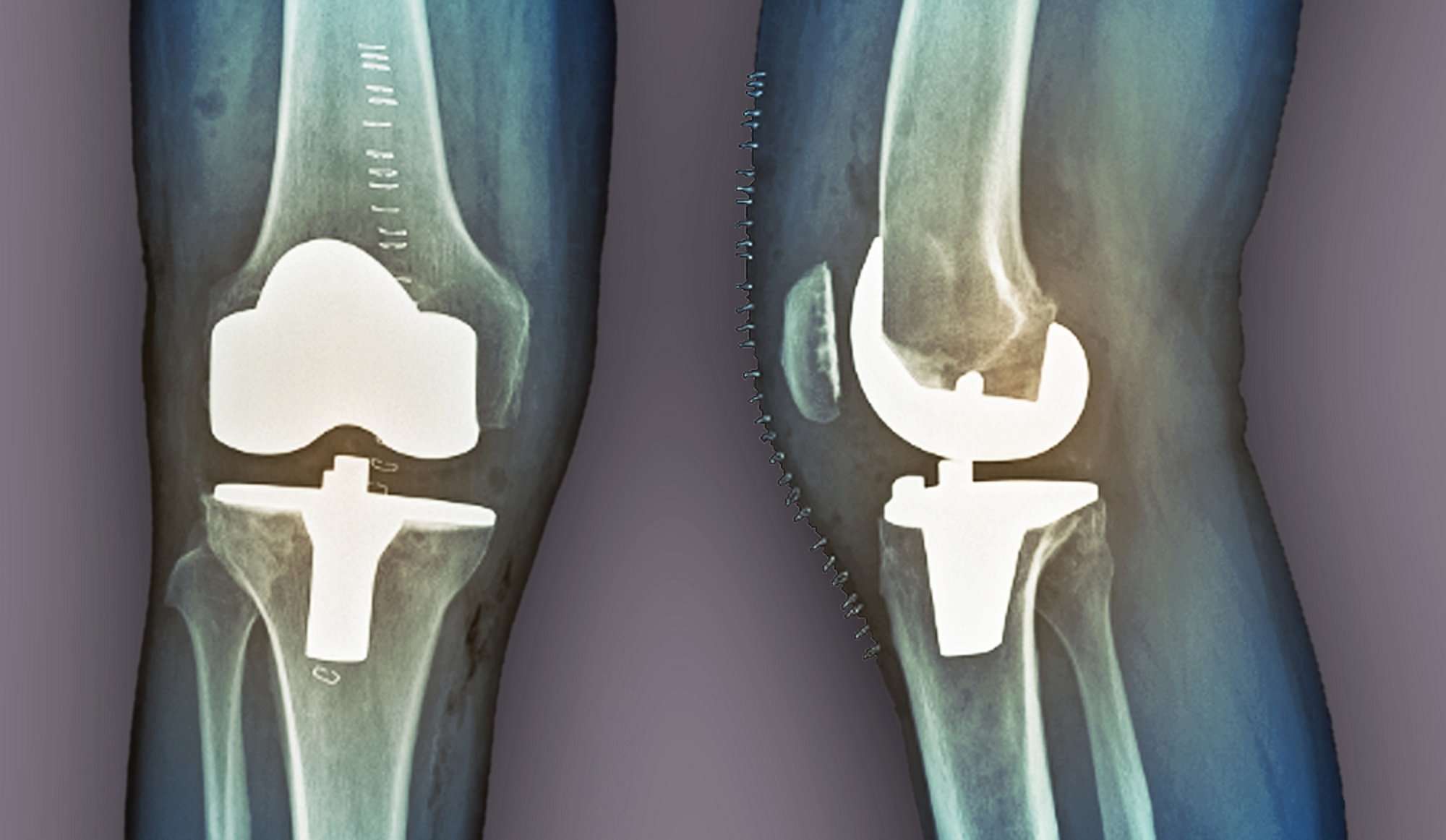 Examining Total Knee Arthroplasty Outcomes in Patients ...