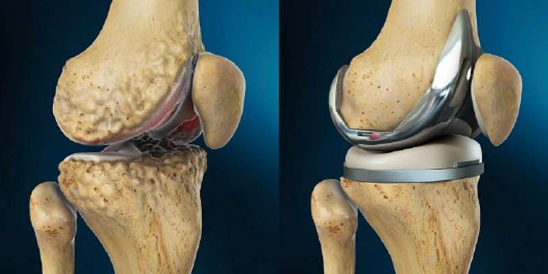 Facts About Total Knee Replacement You Must Know