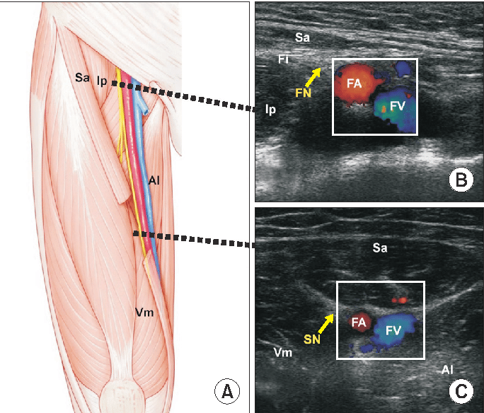 Figure 2 from Femoral Nerve Block versus Adductor Canal Block for ...