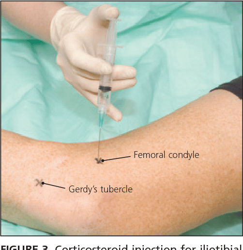 Figure 3 from Iliotibial band syndrome: a common source of knee pain ...