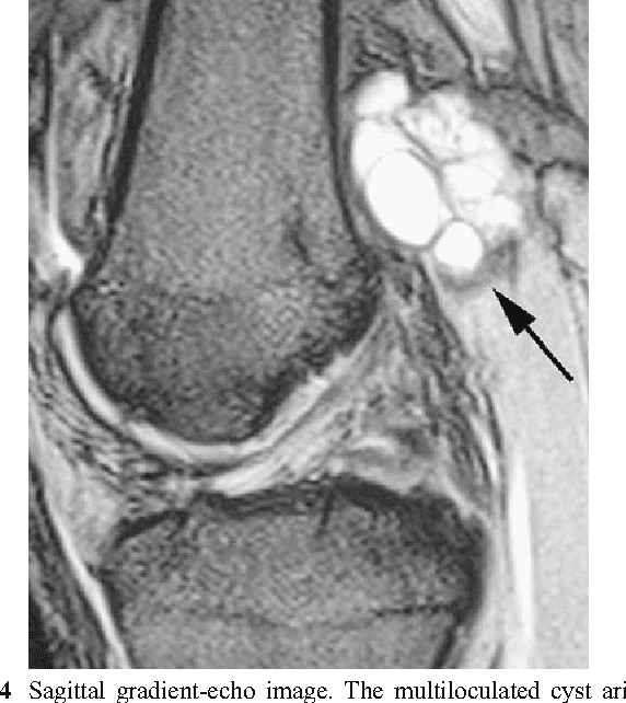 Figure 4 from Ganglion cysts at the gastrocnemius origin: a series of ...