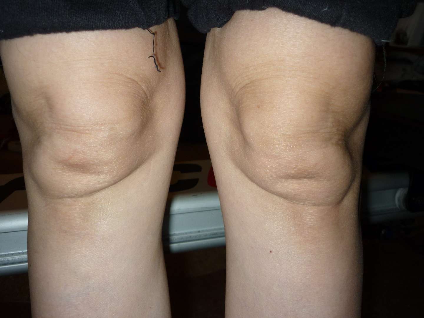 Fleshy, painless lump below knee caps