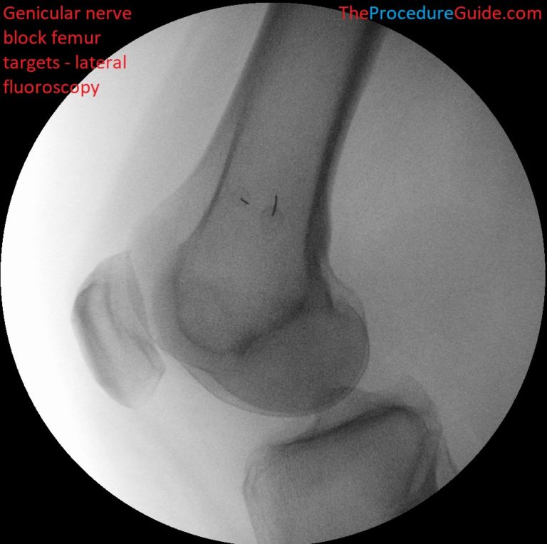 Fluoroscopic Guided Knee Genicular Nerve Block