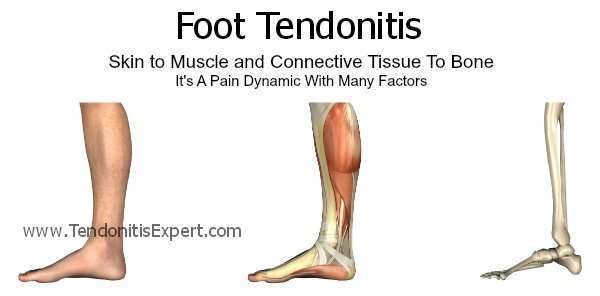 Foot Tendonitis, Tendonitis In Foot