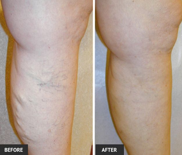 Forget About Hiding Your Legs â Get Rid of the Blue Veins Quickly And ...