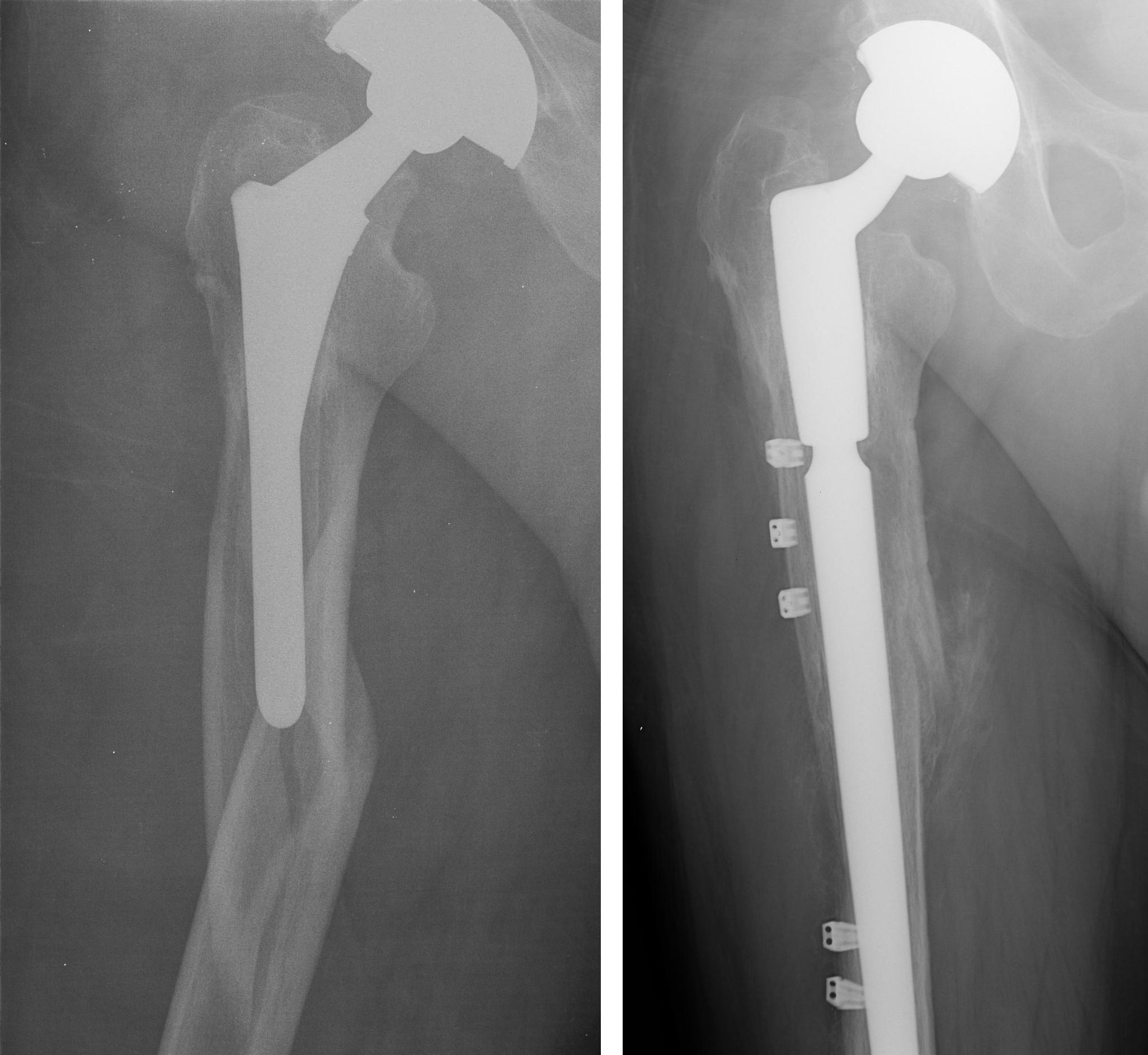 Fracture After Total Hip Replacement