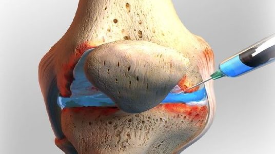 Gel Injections For Knee Arthritis