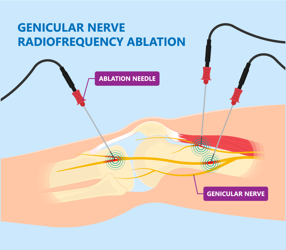 Genicular Nerve Block for Chronic Knee Pain