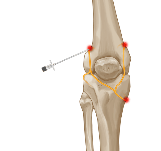 Genicular Nerve Radiofrequency Ablation for Chronic Knee Pain