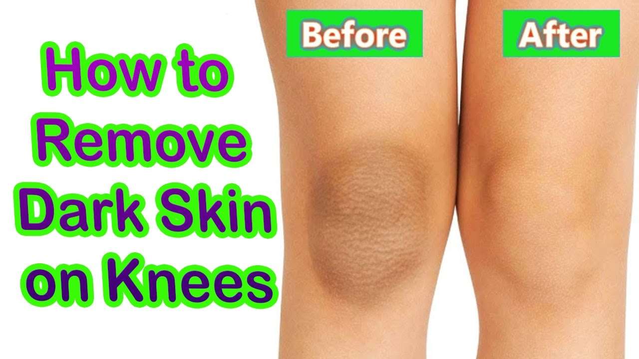Get rid of elbows and knees black spots in just 4 steps ...