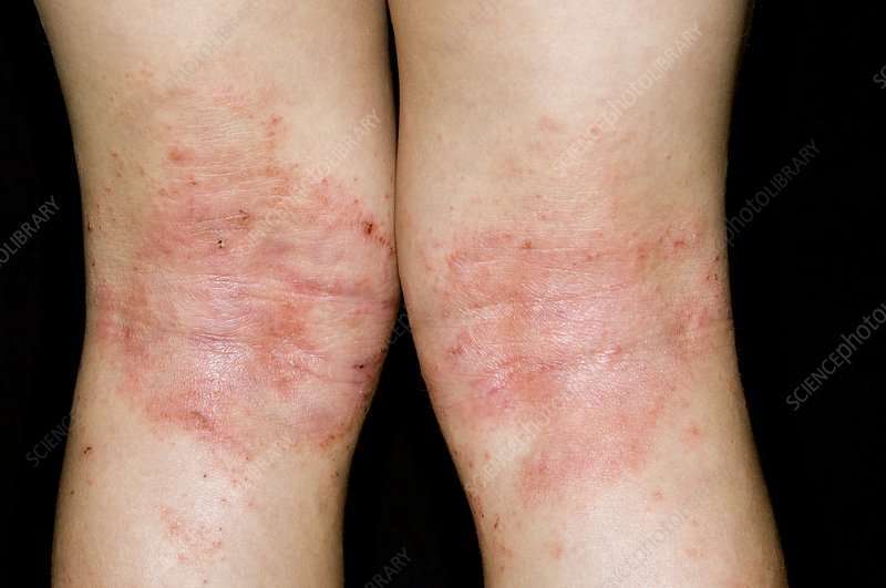 Get rid of Itching and Eczema