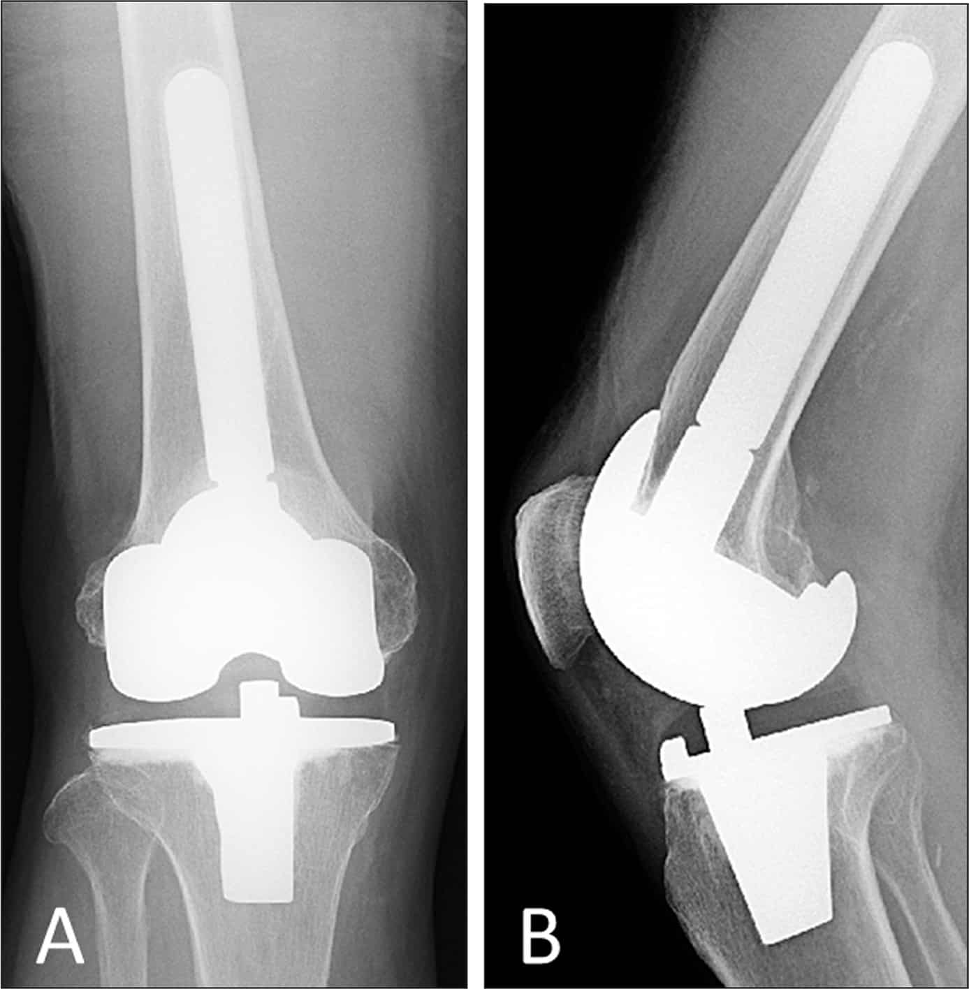 Giant Intraosseous Cyst in an Osteoarthritic Knee