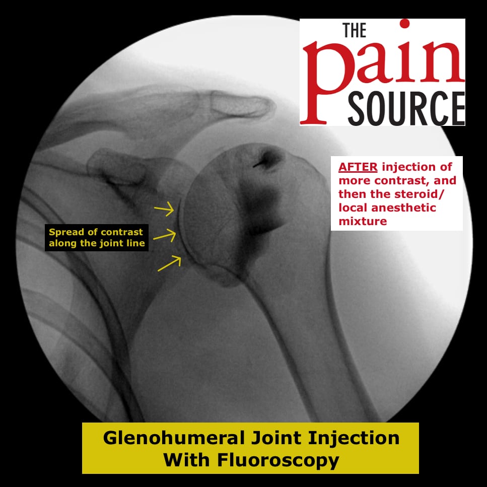 Glenohumeral Joint Injection With Fluoroscopy