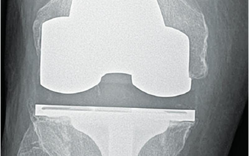 Global study finds high success rate for hip and knee ...