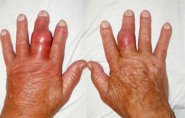 Gout disease pictures, signs of gout pictures, gout ...