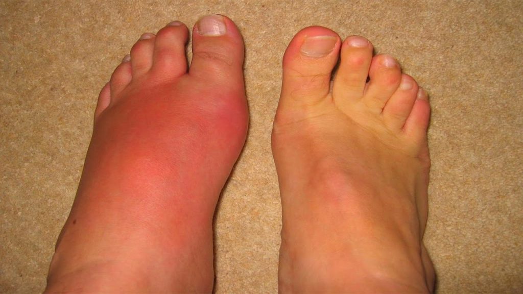 Gout in Pictures