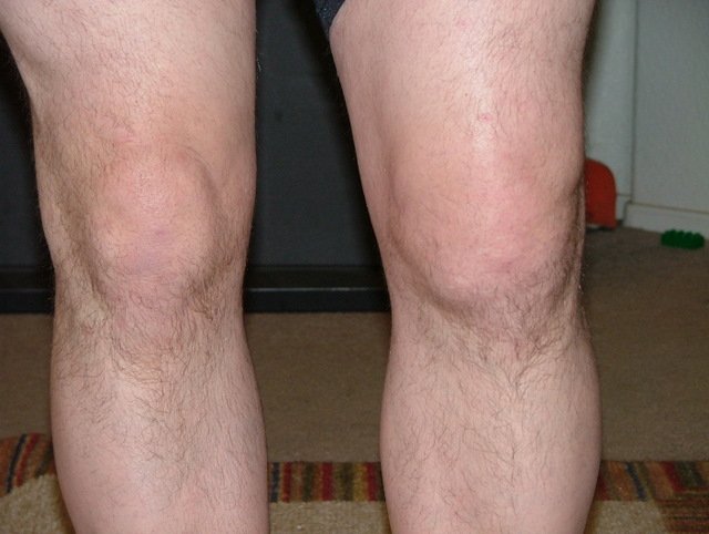 Gout in the Knee