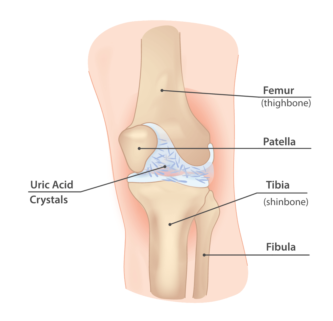 Gout Knee Pain