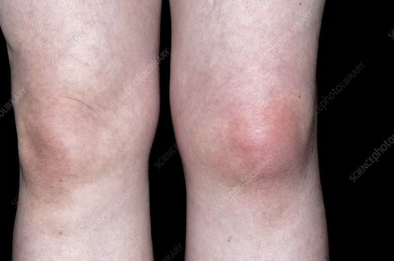 Gout of the knee joint