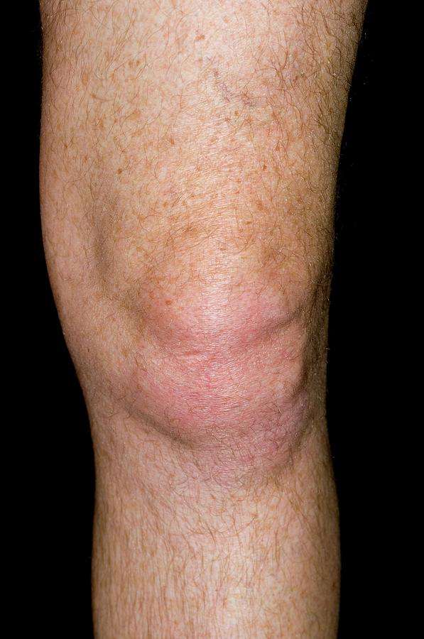 Gout Of The Knee Photograph by Dr P. Marazzi/science Photo ...