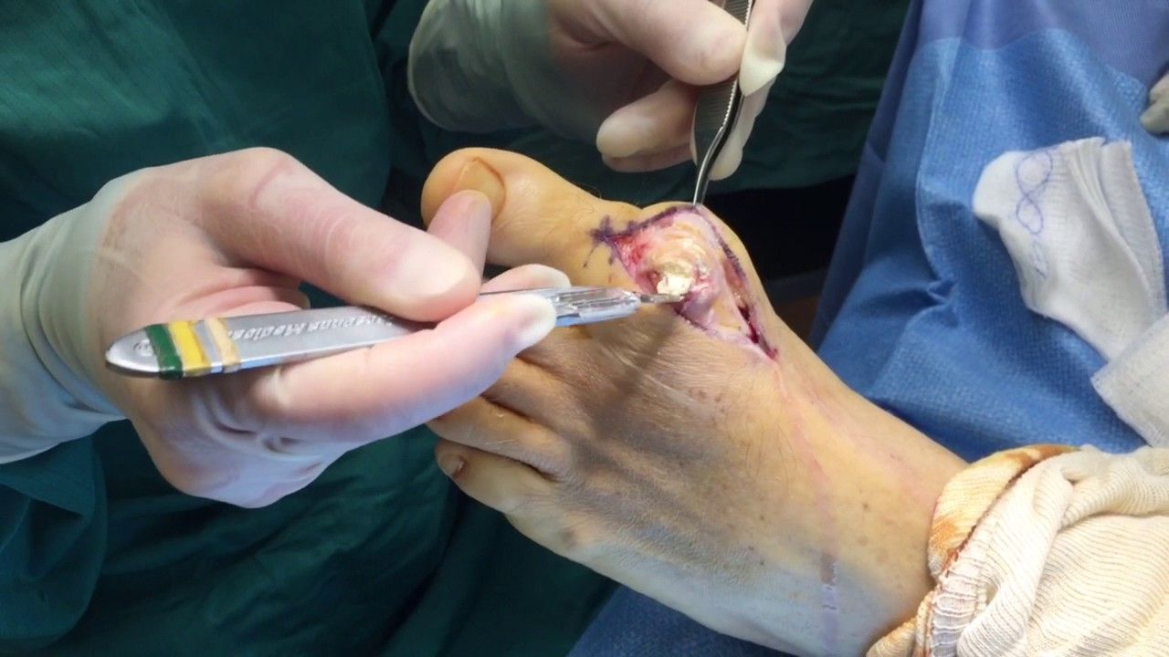 Gout Surgery removing gout crystals 1