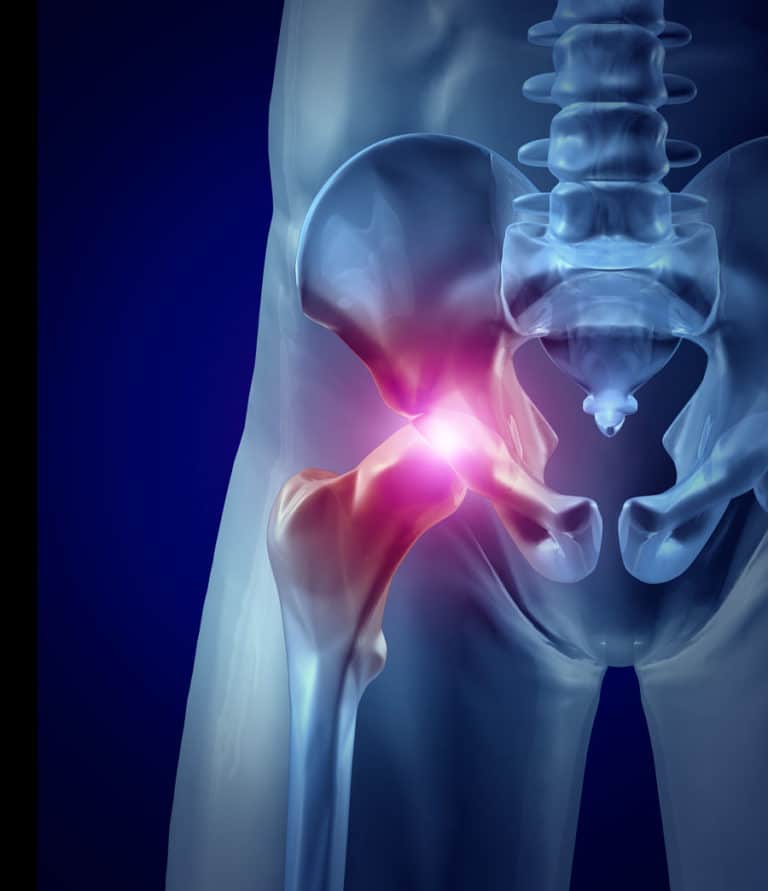 Grand Junction Hip &  Knee Injuries Lawyers