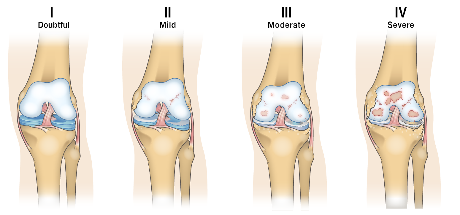 Guide to Severe Knee Arthritis (Osteoarthritis)