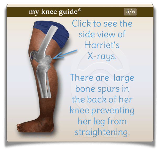 Harriet: Large bone spurs were removed from the back of Harriets
