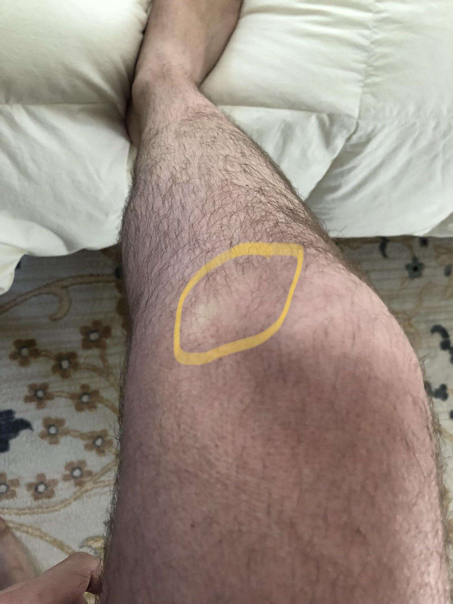 Having a bit of knee pain in the circled area