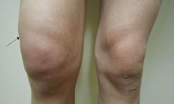 Here is a Natural Way To Get Rid Of Knee Pain and Water in ...