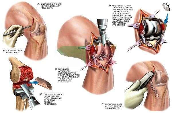Hip Replacement medical procedure by best orthopedic ...