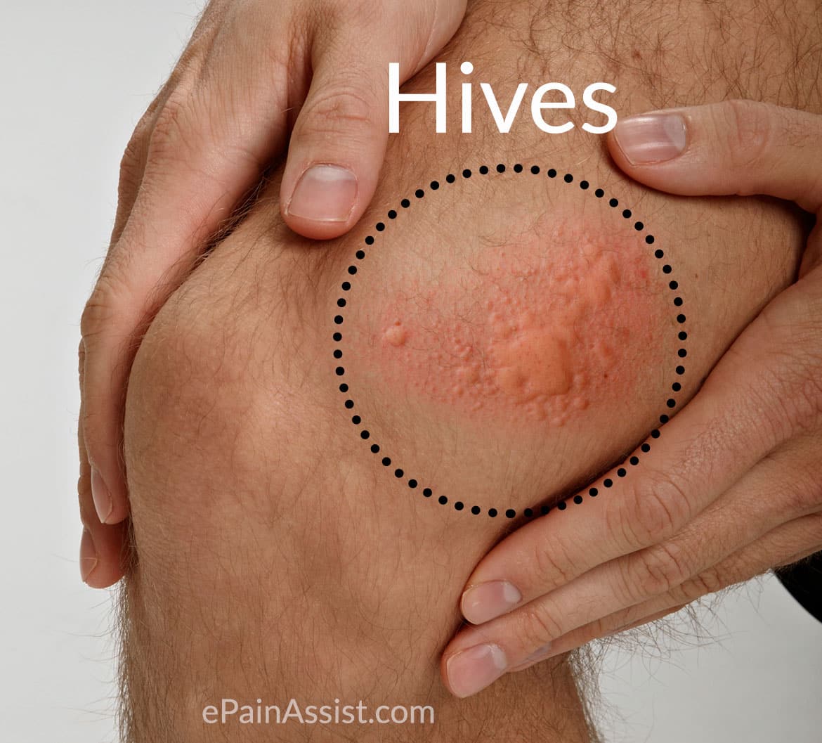 Hives &  Angioedema: Treatment, Home Remedies, Prevention, Causes