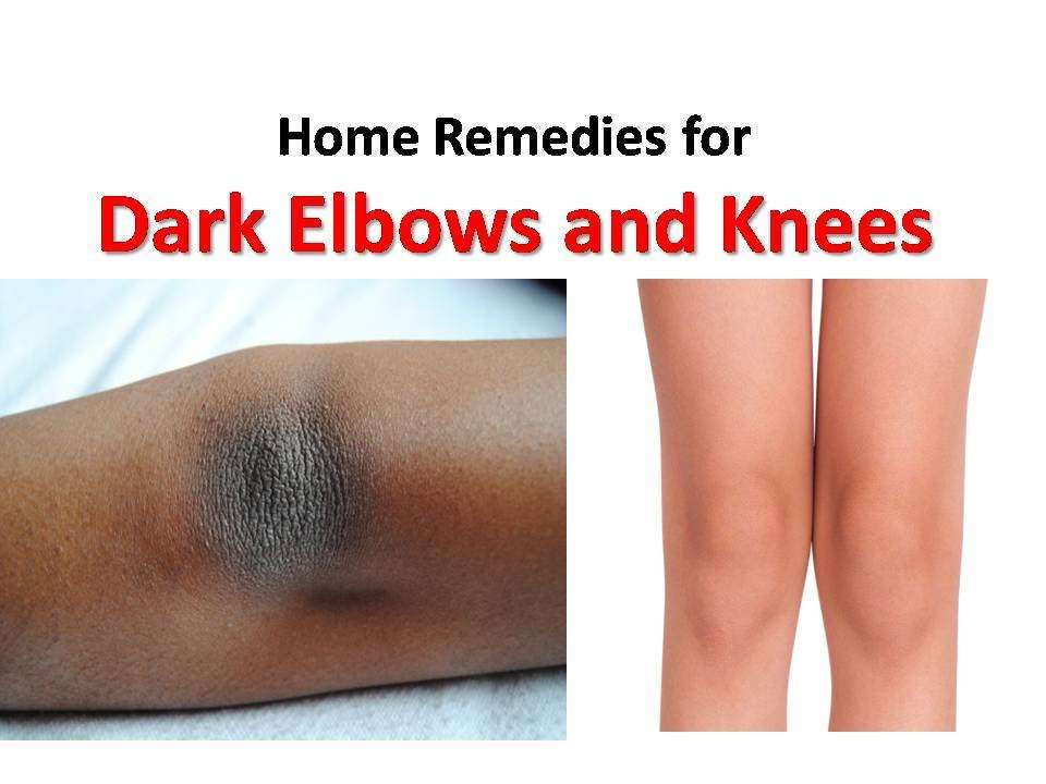 Home Remedies for Dark Elbows and Knees