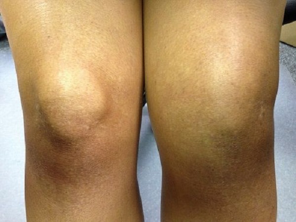 How Bad Is the Pain after Knee Replacement Surgery
