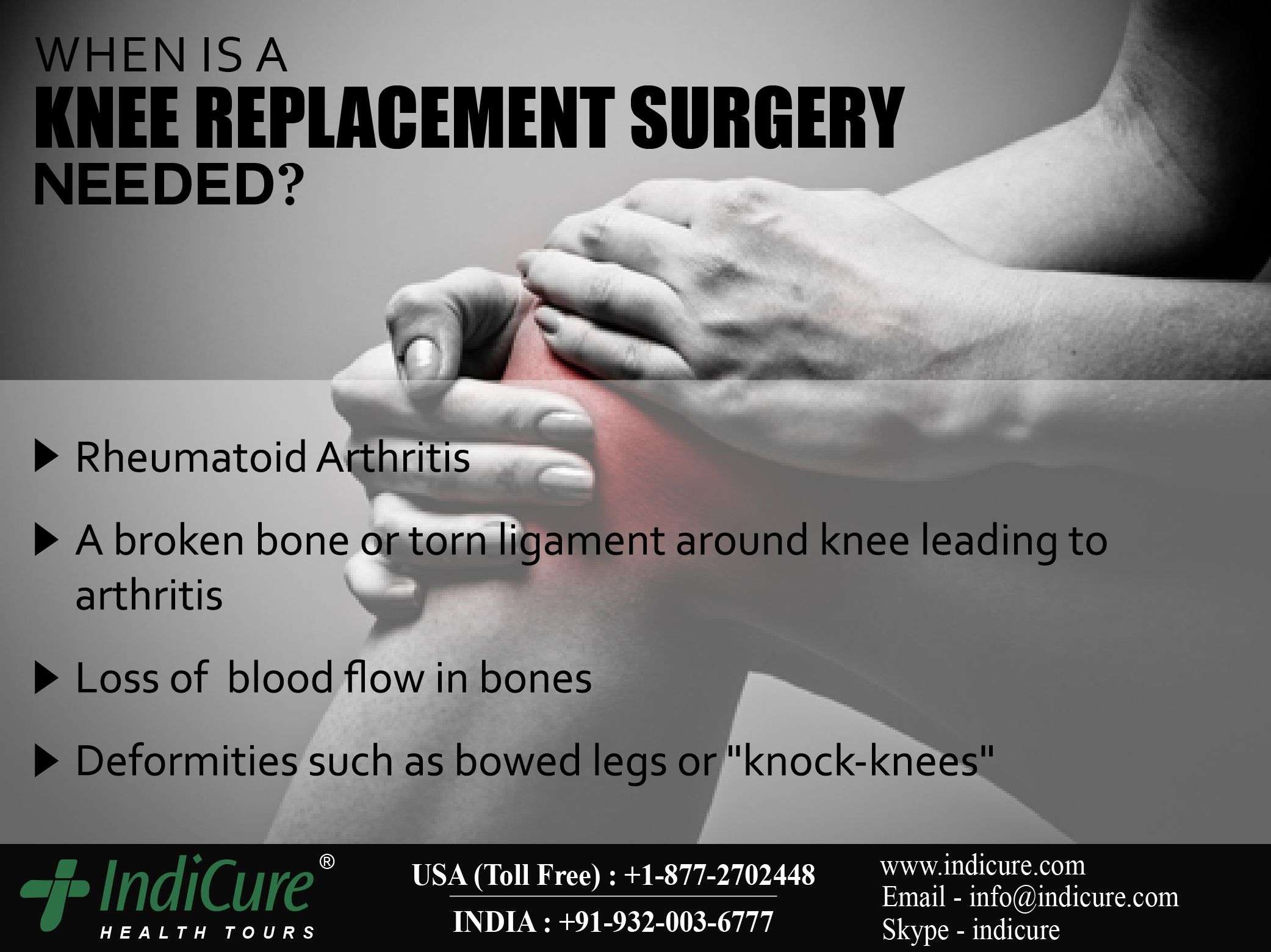 How Do I Know If I Need Knee Replacement Surgery?