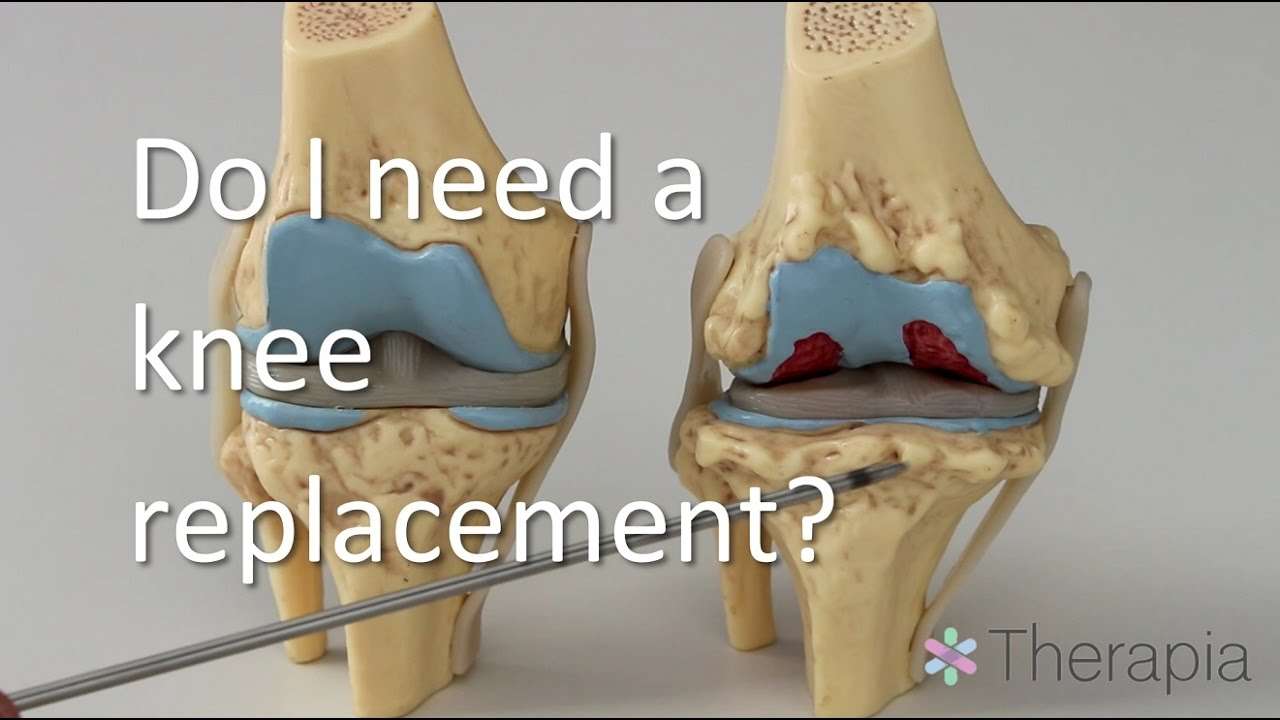 How Do You Spell Knee Replacement : Knee Pain Arthritis And Injured ...
